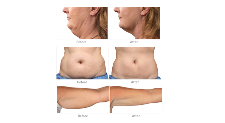 preço da máquina de criolipólise