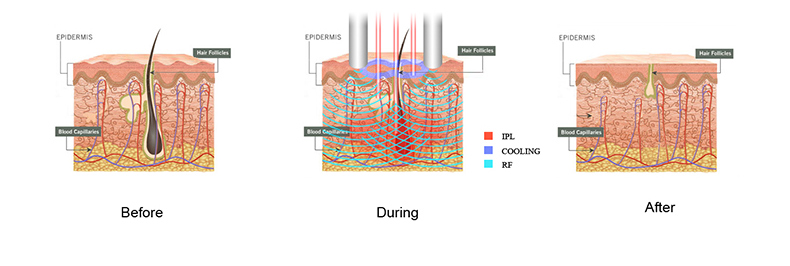 SHR-IPL--SHR SHR-IPL--SHR