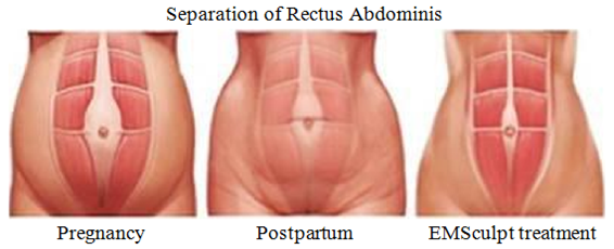 Melhorar a separa&ccedil;&atilde;o de reto abdominis.