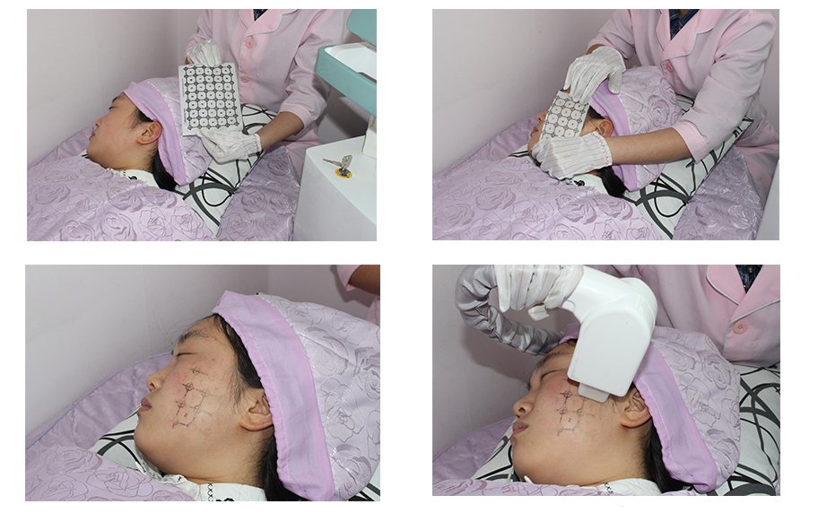 Thermage Fractional RF dispositivo antienvelhecimento