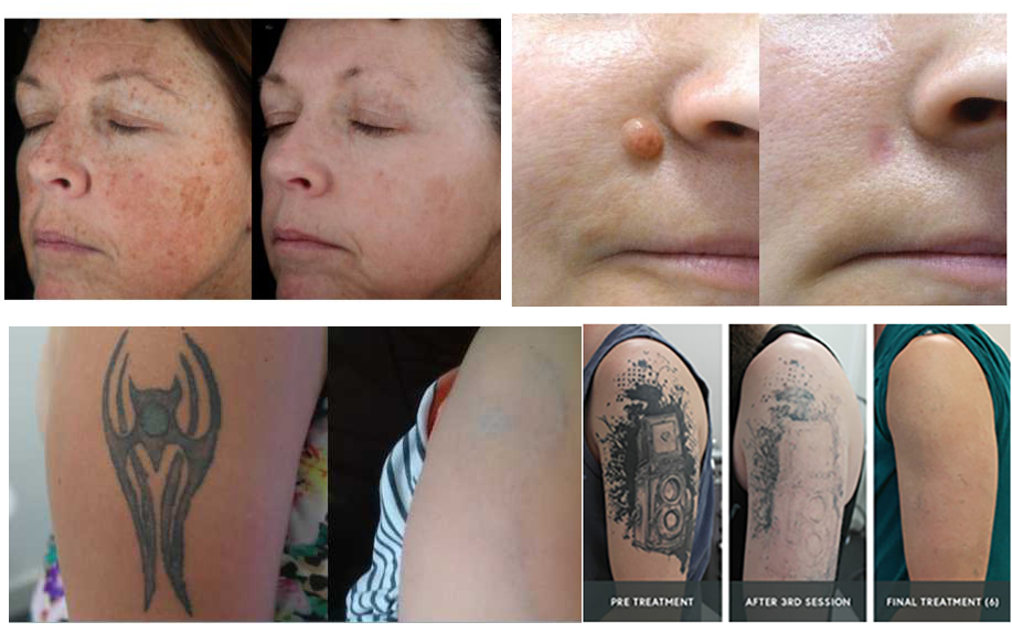 remo&ccedil;&atilde;o de tatuagem