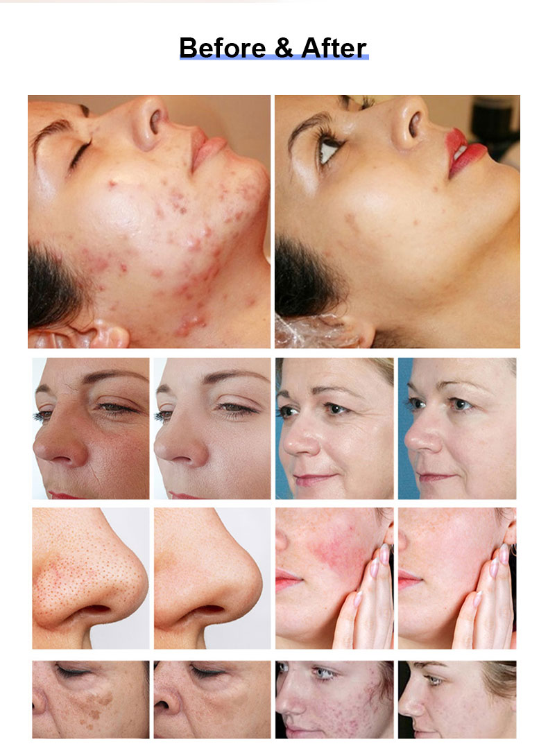 1927nm thulium fracion&aacute;rio laser