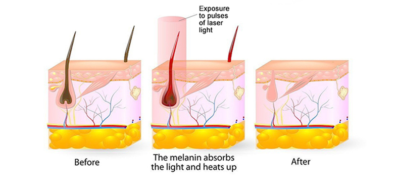 m&aacute;quina de remo&ccedil;&atilde;o de cabelo a laser