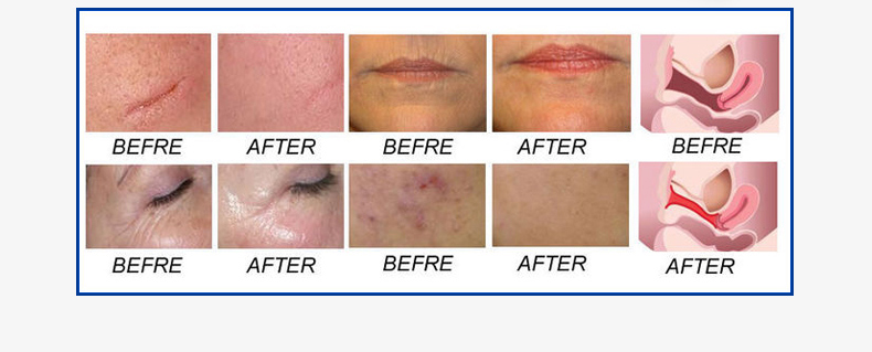 M&aacute;quina laser fracion&aacute;ria profissional de CO2