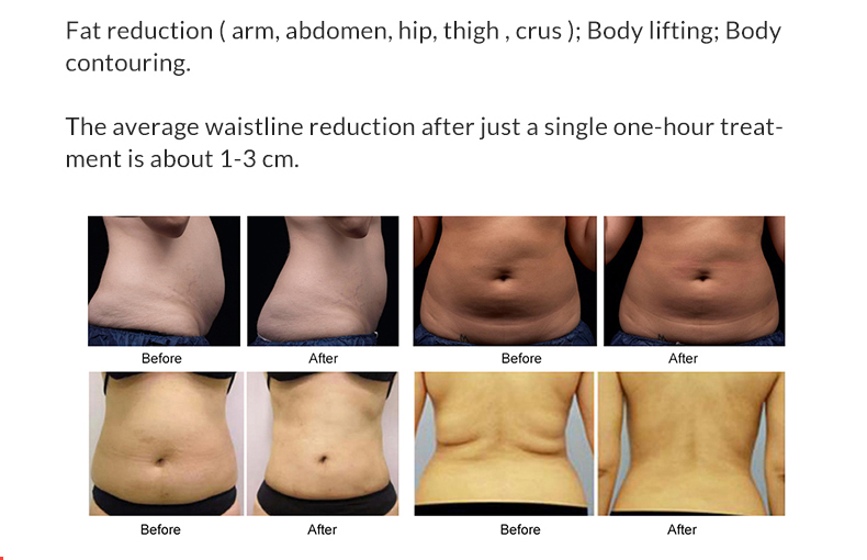 M&aacute;quina de emagrecimento corporal Hifu Liposonix