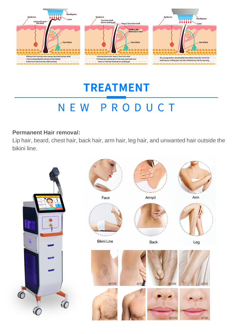 Depila&ccedil;&atilde;o a laser de diodo