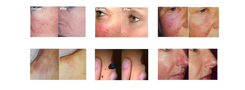 Remo&ccedil;&atilde;o vascular