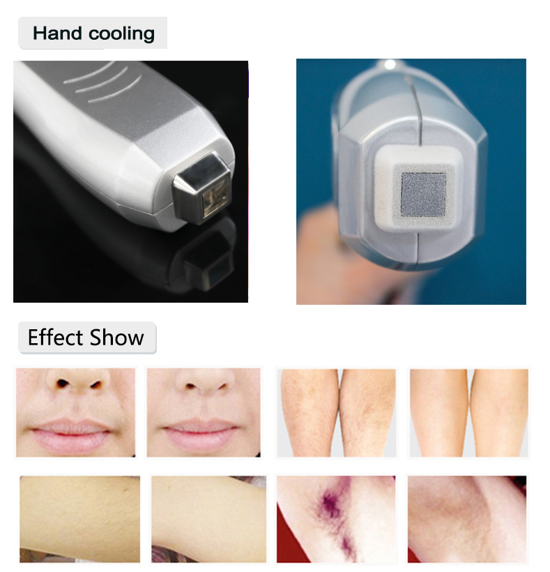 depila&ccedil;&atilde;o &agrave; laser