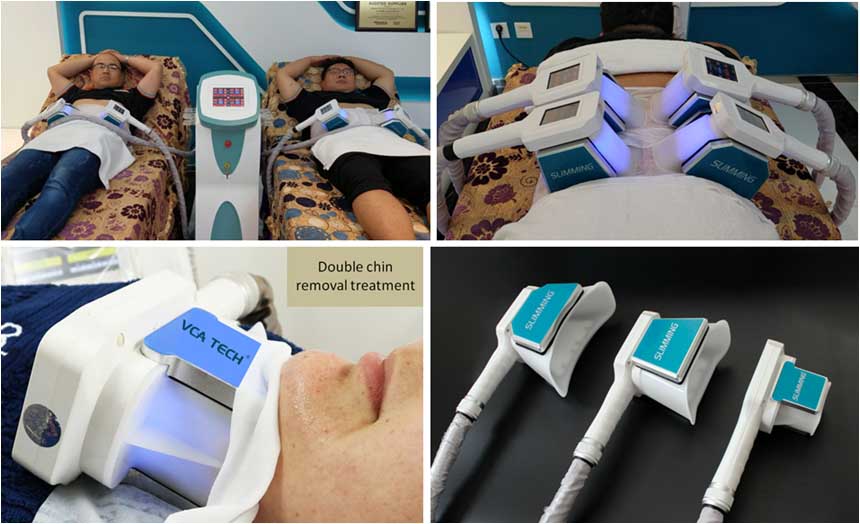 Máquina de emagrecimento por congelamento de gordura por criolipólise com 4 alças trabalha em conjunto