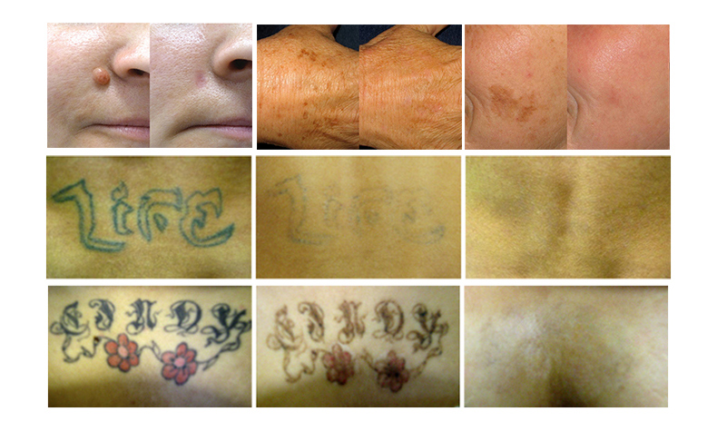 M&aacute;quina de remo&ccedil;&atilde;o de tatuagem