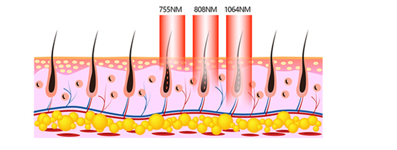 teoria da m&aacute;quina de remo&ccedil;&atilde;o de cabelo