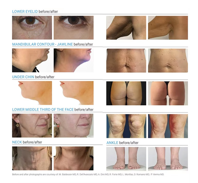 m&aacute;quina de lip&oacute;lise a laser de diodo