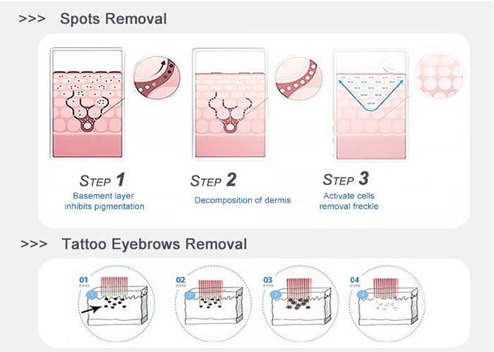 laser de picossegundos