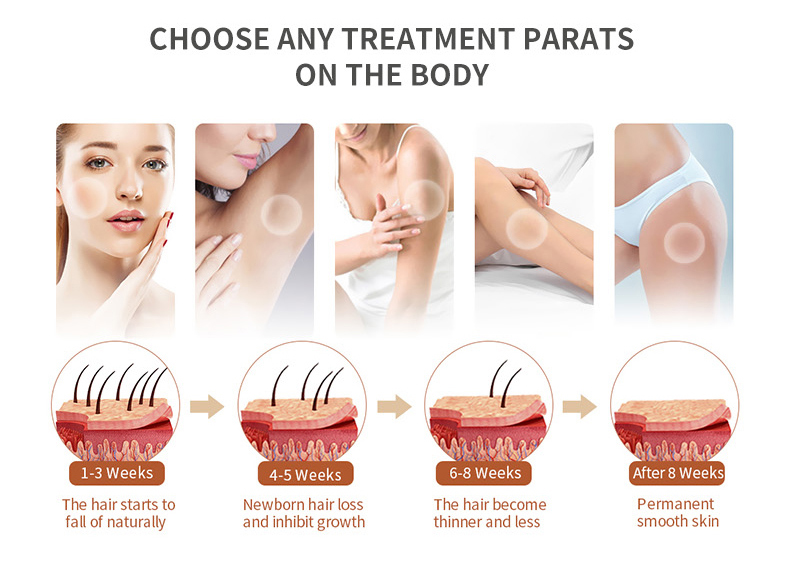 m&aacute;quina de depila&ccedil;&atilde;o 808