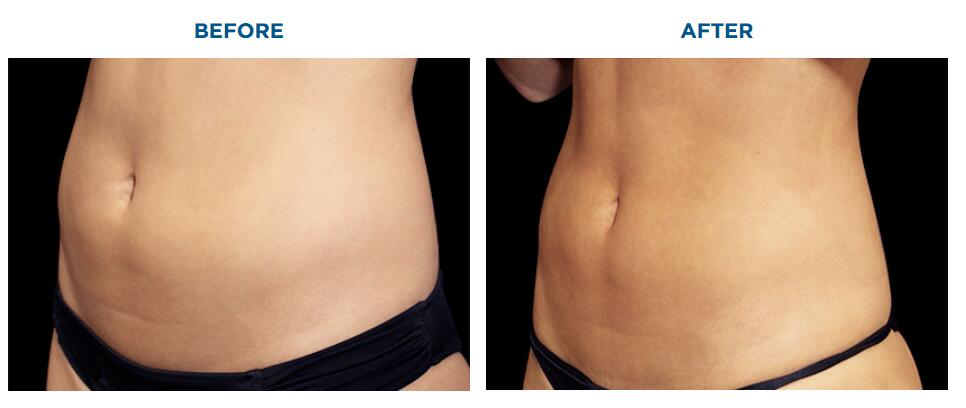 M&aacute;quina de perda de peso