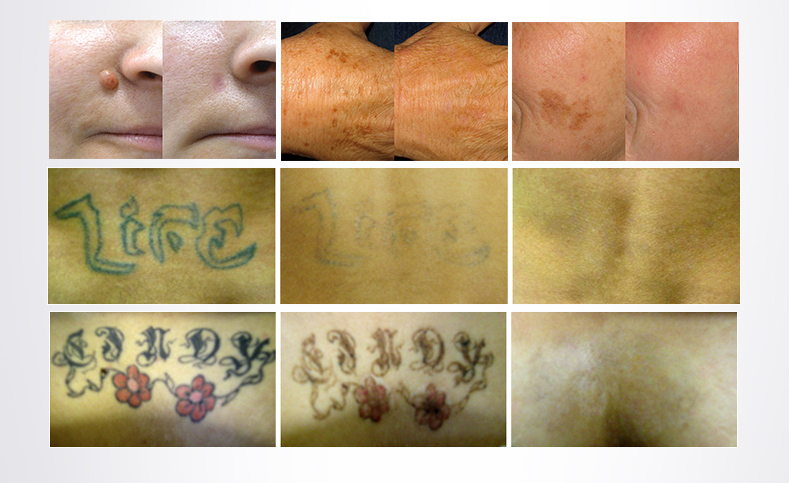 Aprovação CE Laser Beauty Equipment remoção de tatuagem q comutada nd yag lase preço