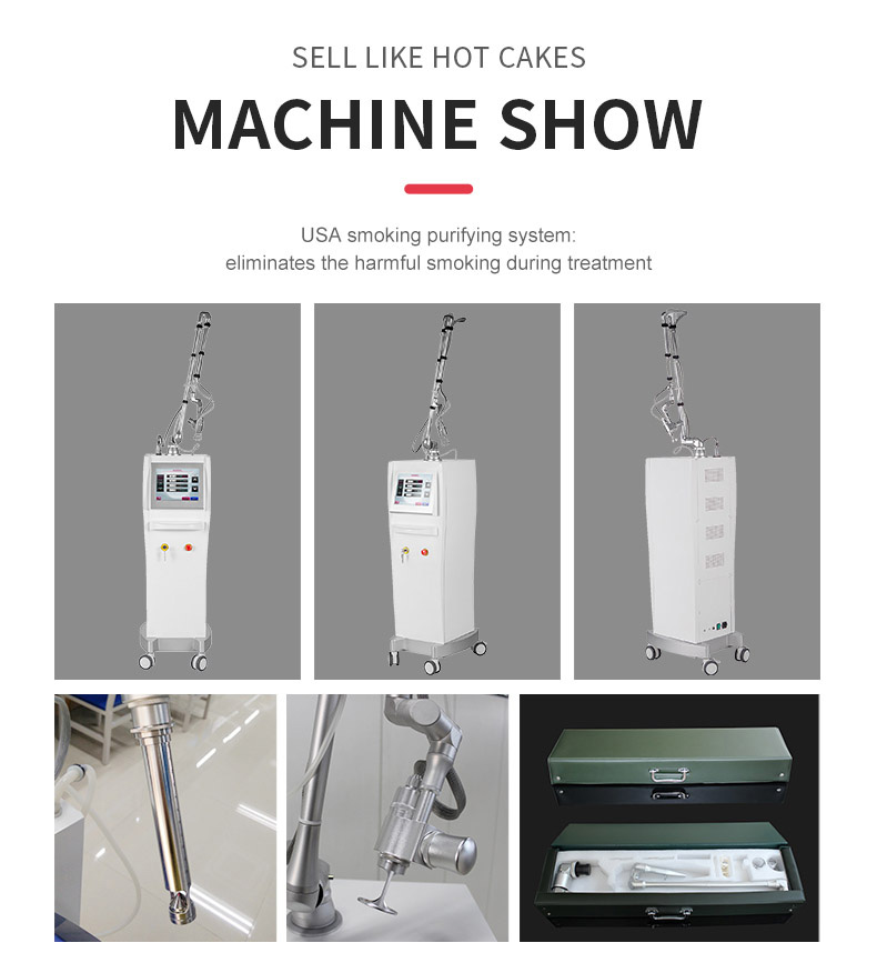 Remo&ccedil;&atilde;o de acne de estrias