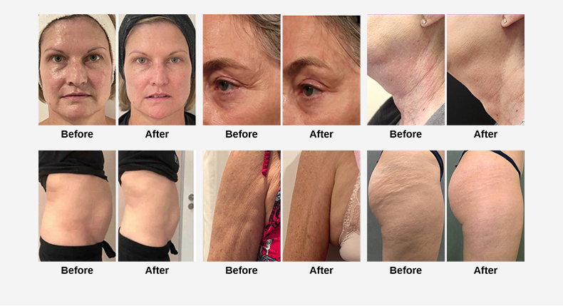 M&aacute;quina de remo&ccedil;&atilde;o de rugas para HIFU