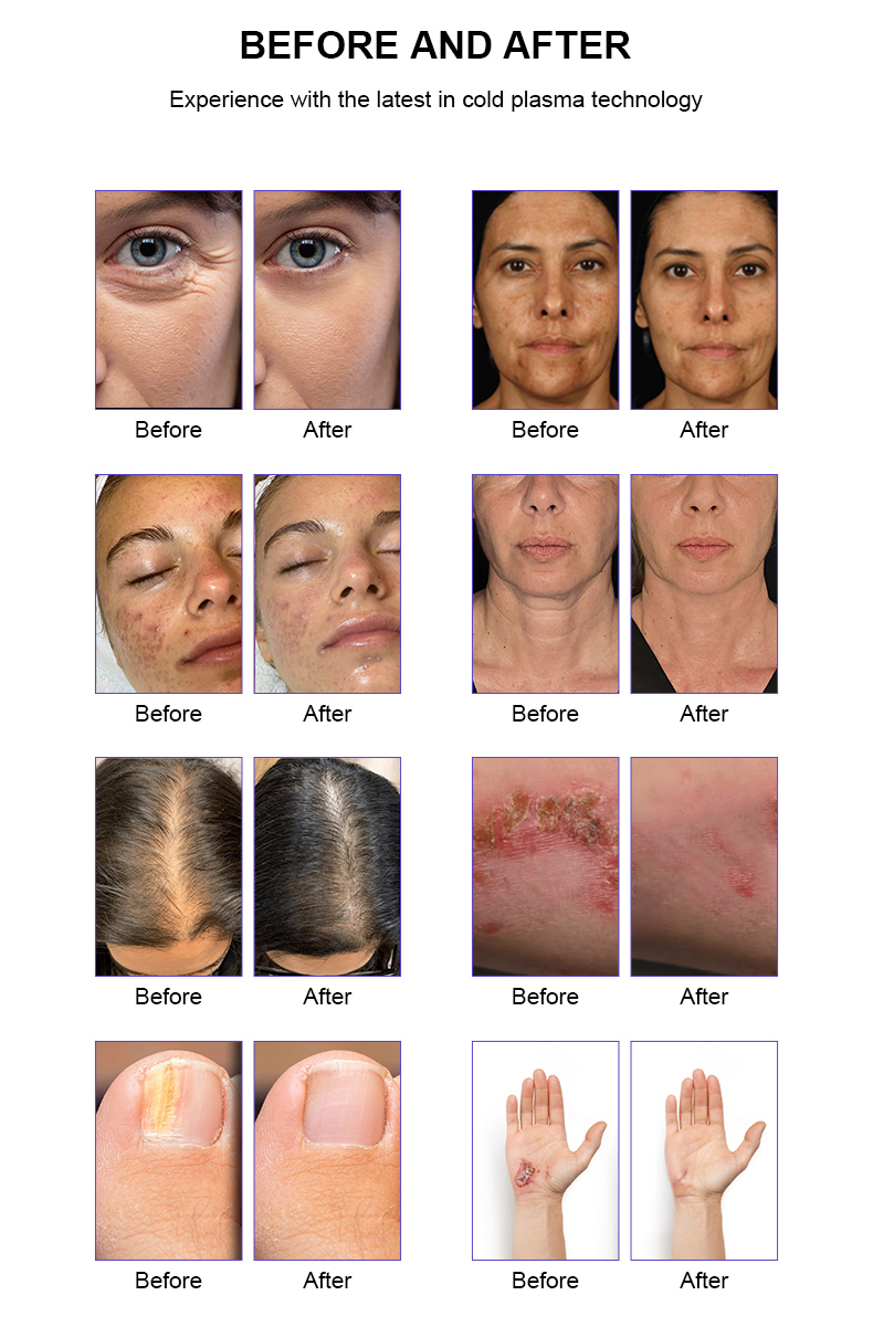 M&aacute;quina de plasma frio