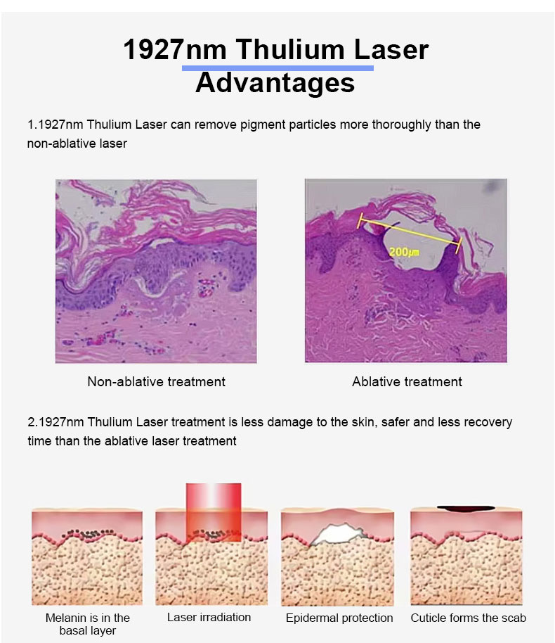 1927nm thulium laser fracion&aacute;rio