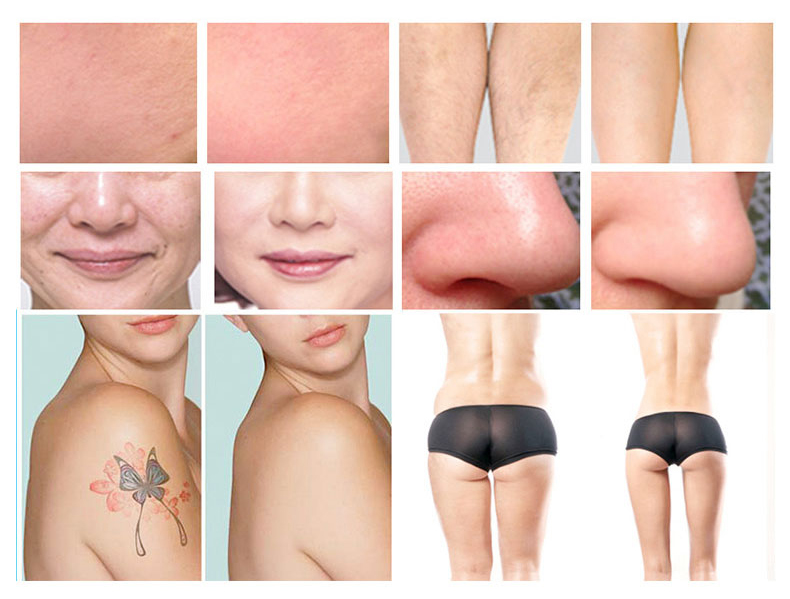 E-light + NdYAG Laser + lipolaser + RF