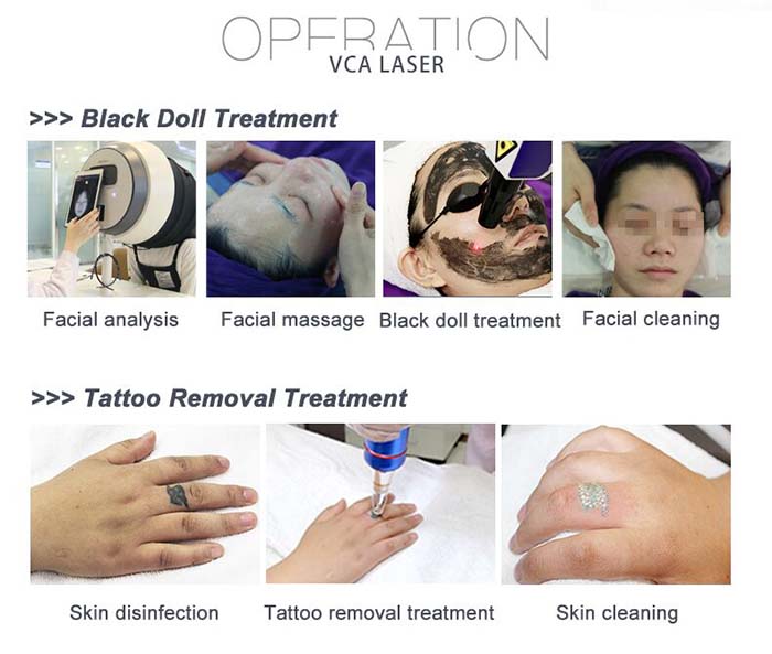 LASER PICOSECOND ND YAG para remoção de tatuagens e pigmentos