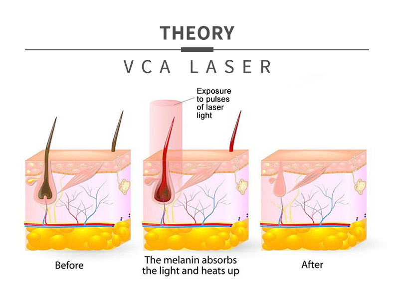 Depila&ccedil;&atilde;o &agrave; laser