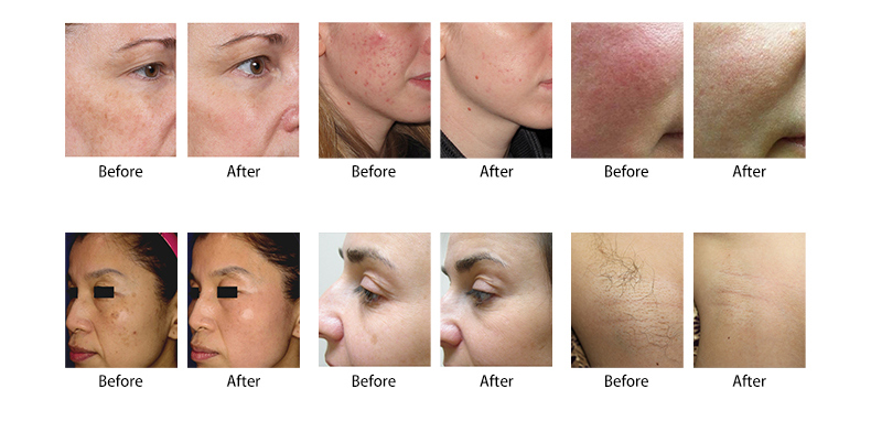 M&aacute;quina de rejuvenescimento da pele