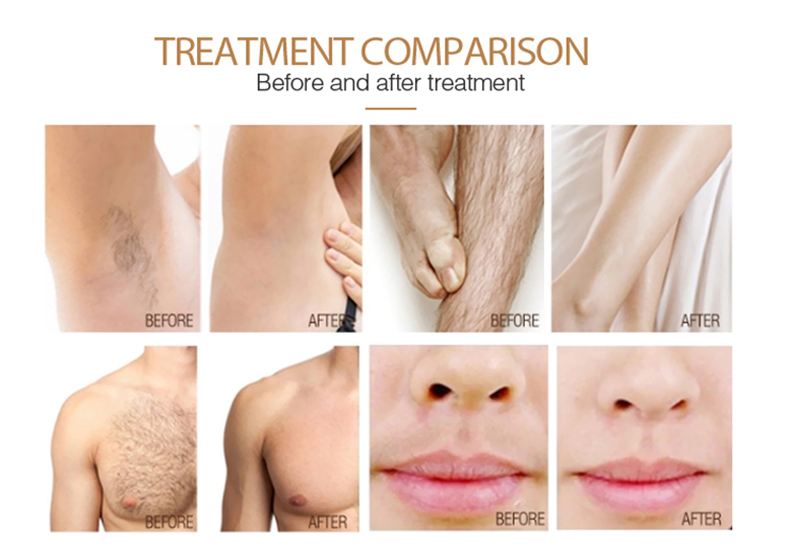 M&aacute;quina de diodo de remo&ccedil;&atilde;o de cabelo a laser