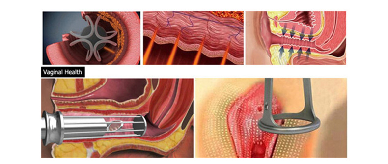 M&aacute;quina laser fracion&aacute;ria profissional de CO2