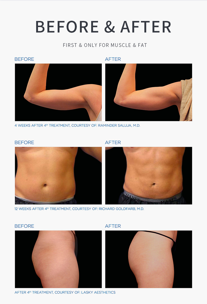 M&aacute;quina de escultura corporal EMS