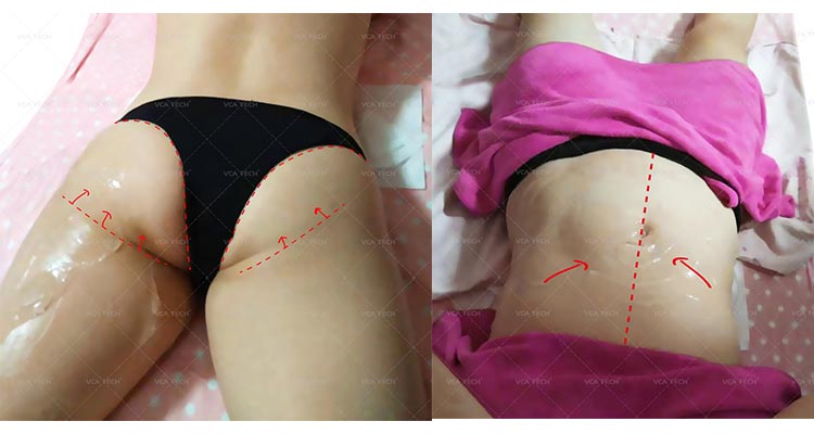 M&aacute;quina de remo&ccedil;&atilde;o de rugas