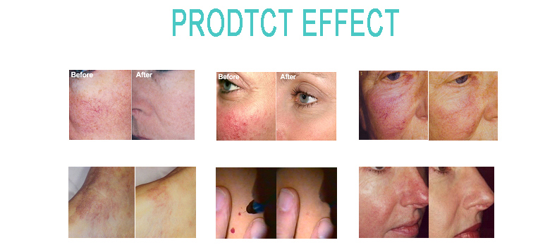 M&aacute;quina de remo&ccedil;&atilde;o de veias de aranha