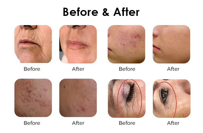 1550nm de vidro de erbio&nbsp; Laser&nbsp;