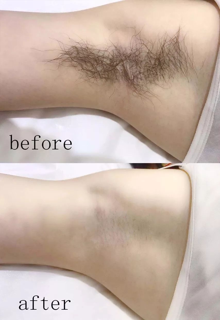 Como remover os pelos rapidamente?