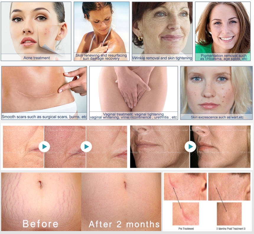 Laser de co2 fracionado