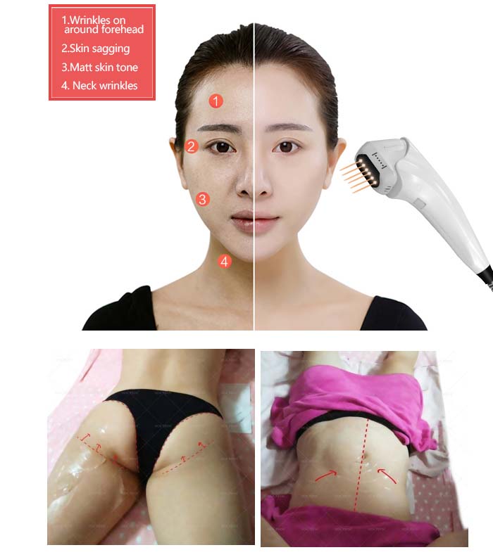 m&aacute;quina de remo&ccedil;&atilde;o de rugas