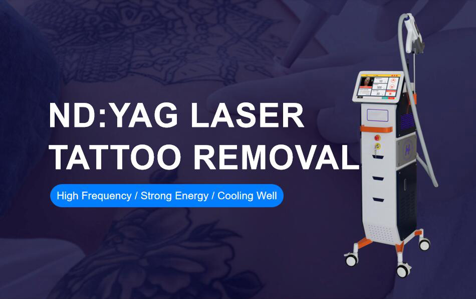 Máquina a laser para remoção de tatuagens