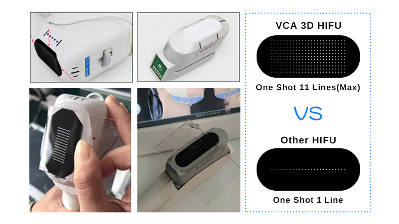 M&aacute;quina de remo&ccedil;&atilde;o de rugas para HIFU