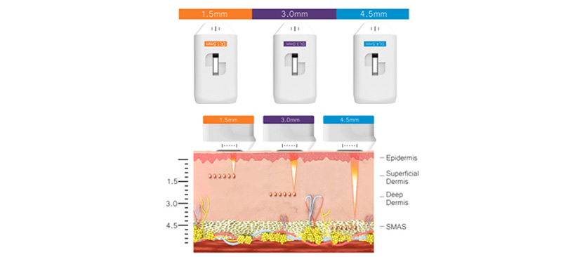 M&aacute;quina hifu profissional
