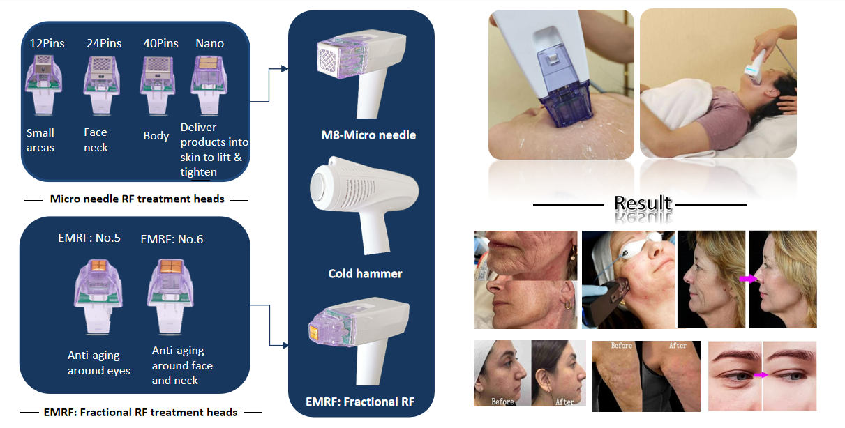M&aacute;quina de agulha micro
