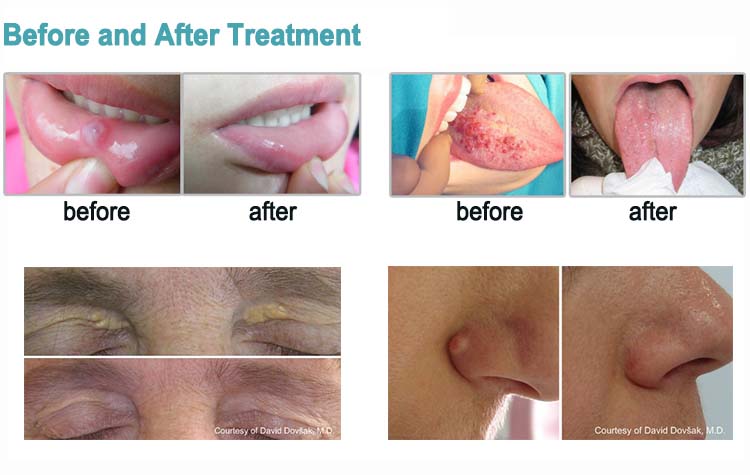 aperto vaginal de co2 fracionado