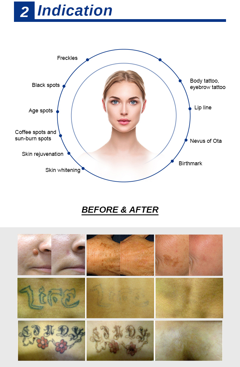 Remo&ccedil;&atilde;o de tatuagem a laser