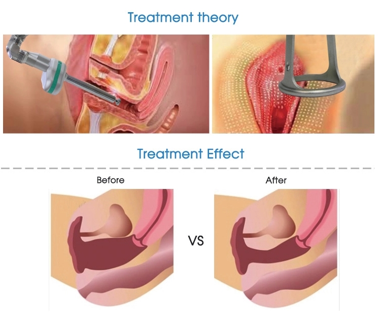 laser de aperto vaginal