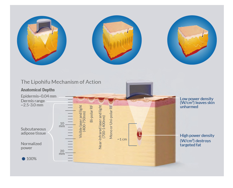 M&aacute;quina de emagrecimento corporal Hifu Liposonix