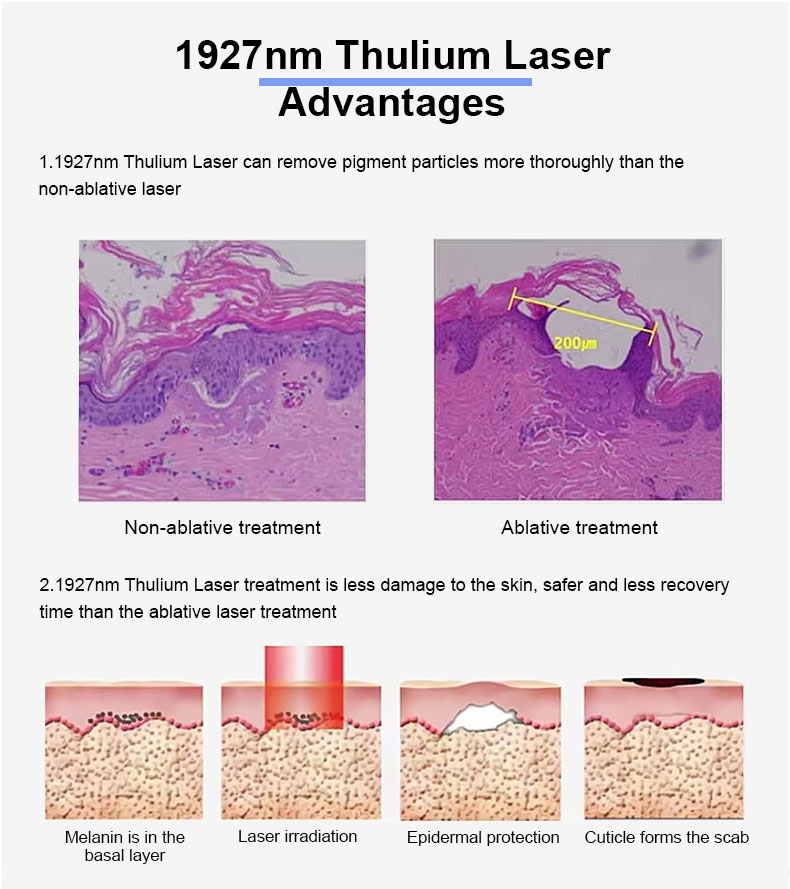 1927nm thulium fracion&aacute;rio laser