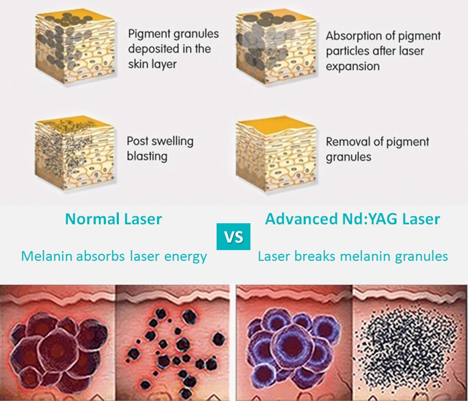 laser de picossegundo 