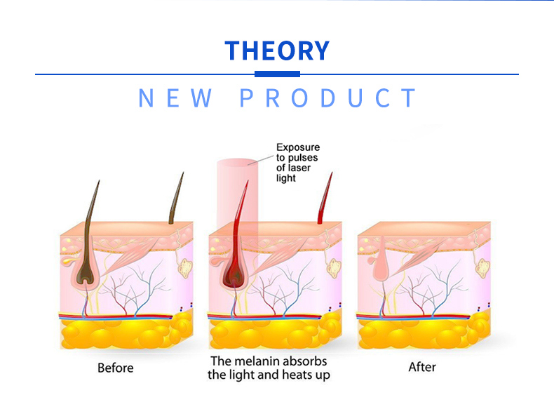 m&aacute;quina de depila&ccedil;&atilde;o