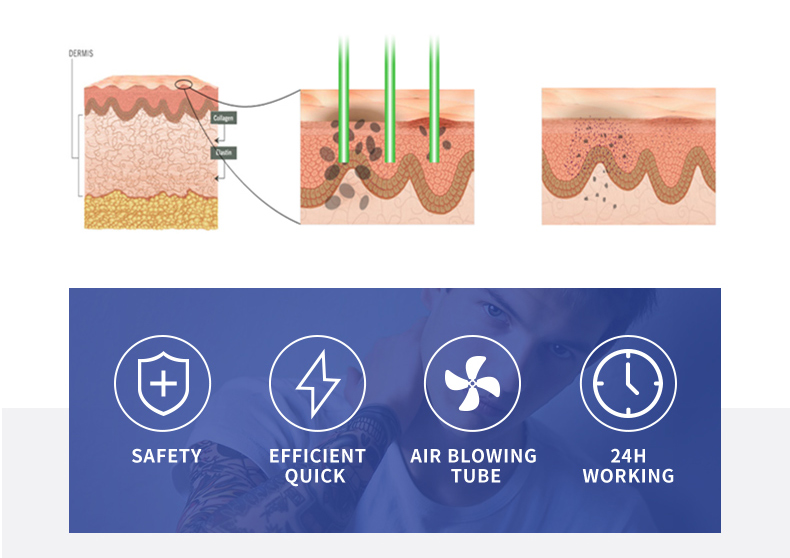 M&aacute;quina de remo&ccedil;&atilde;o de tatuagem