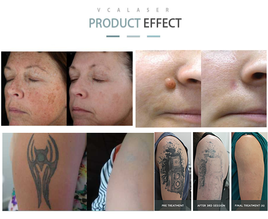 laser de picossegundo